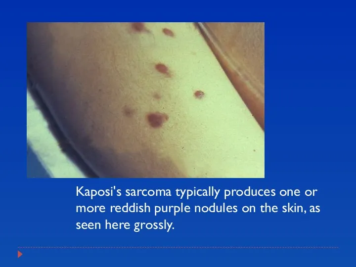 Kaposi's sarcoma typically produces one or more reddish purple nodules on