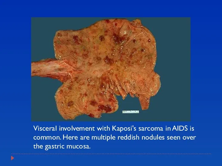 Visceral involvement with Kaposi's sarcoma in AIDS is common. Here are