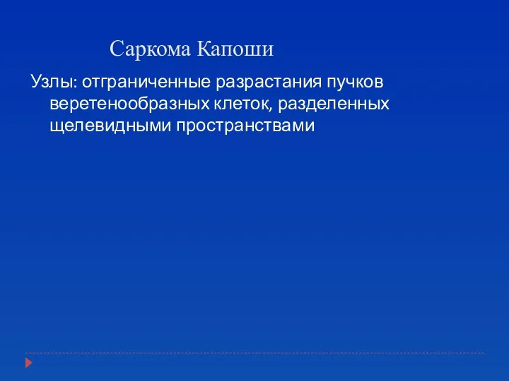 Саркома Капоши Узлы: отграниченные разрастания пучков веретенообразных клеток, разделенных щелевидными пространствами