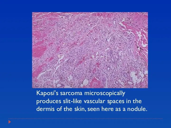 Kaposi's sarcoma microscopically produces slit-like vascular spaces in the dermis of