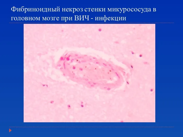 Фибриноидный некроз стенки микурососуда в головном мозге при ВИЧ - инфекции