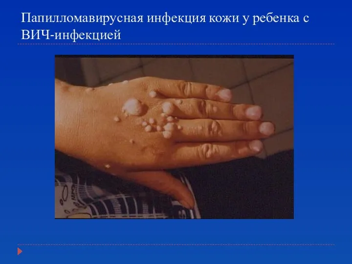 Папилломавирусная инфекция кожи у ребенка с ВИЧ-инфекцией