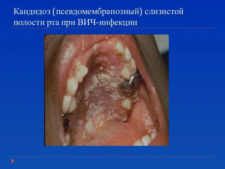 Кандидоз (псевдомембранозный) слизистой полости рта при ВИЧ-инфекции