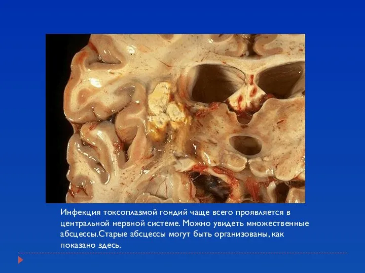 Инфекция токсоплазмой гондий чаще всего проявляется в центральной нервной системе. Можно
