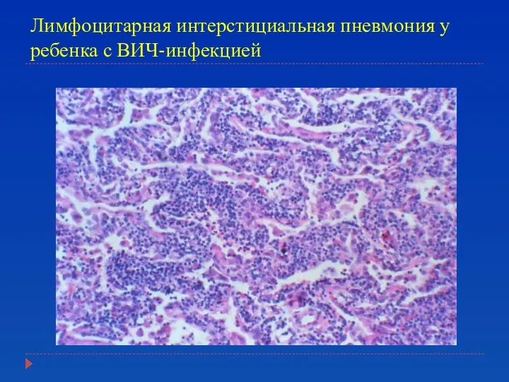 Лимфоцитарная интерстициальная пневмония у ребенка с ВИЧ-инфекцией