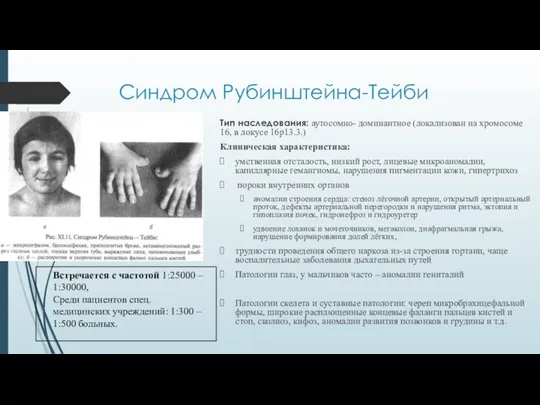 Тип наследования: аутосомно- доминантное (локализован на хромосоме 16, в локусе 16р13.3.)