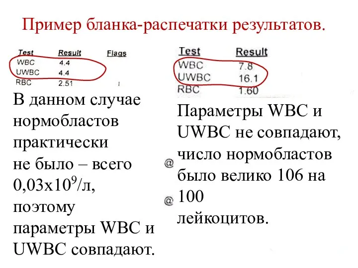 Пример бланка-распечатки результатов. В данном случае нормобластов практически не было –