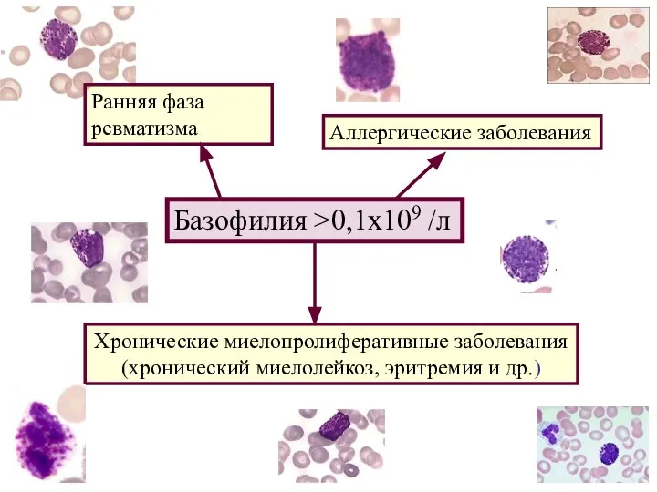 Базофилия >0,1x109 /л Аллергические заболевания Хронические миелопролиферативные заболевания (хронический миелолейкоз, эритремия и др.) Ранняя фаза ревматизма