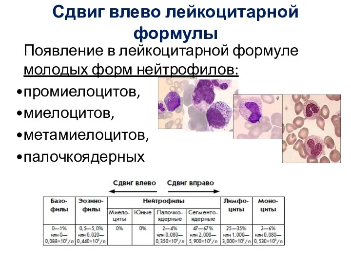 Сдвиг влево лейкоцитарной формулы Появление в лейкоцитарной формуле молодых форм нейтрофилов: промиелоцитов, миелоцитов, метамиелоцитов, палочкоядерных