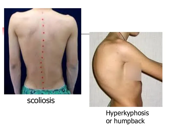 scoliosis Hyperkyphosis or humpback