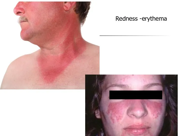 Redness -erythema