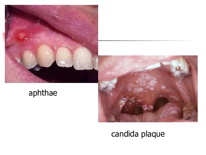 aphthae candida plaque