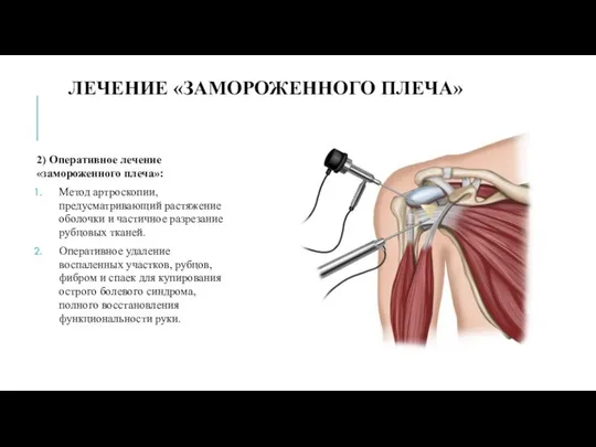 ЛЕЧЕНИЕ «ЗАМОРОЖЕННОГО ПЛЕЧА» 2) Оперативное лечение «замороженного плеча»: Метод артроскопии, предусматривающий