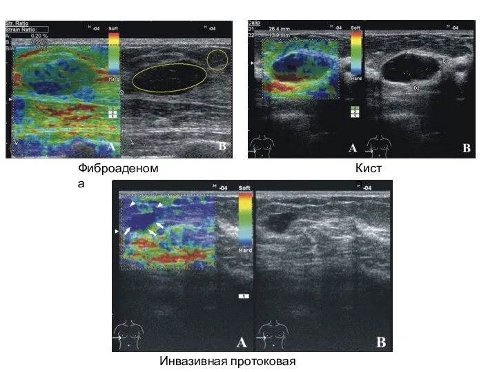 Фиброаденома Киста Инвазивная протоковая карцинома