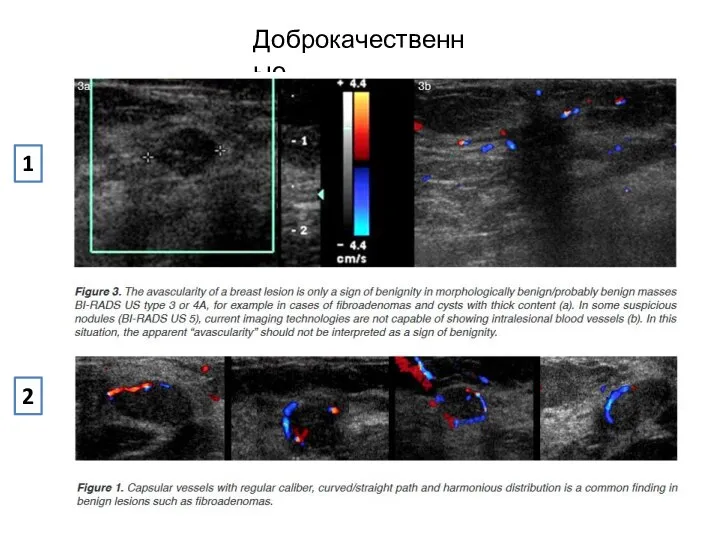 Доброкачественные 1 2