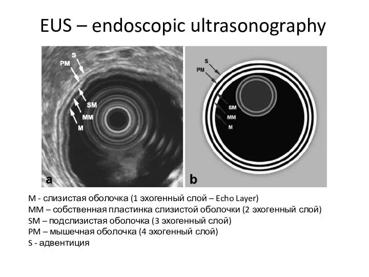 M - слизистая оболочка (1 эхогенный слой – Echo Layer) MM