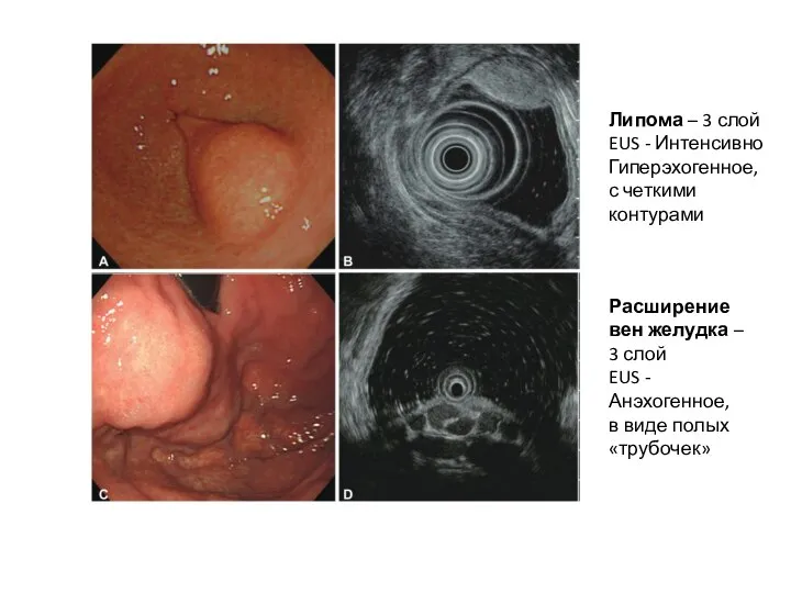 Липома – 3 слой EUS - Интенсивно Гиперэхогенное, с четкими контурами