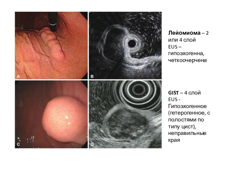 Лейомиома – 2 или 4 слой EUS – гипоэхогенна, четкоочерчена GIST