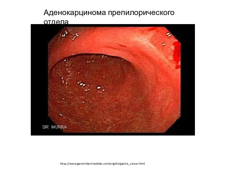 Аденокарцинома препилорического отдела https://www.gastrointestinalatlas.com/english/gastric_cancer.html