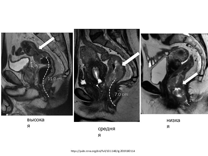 https://pubs.rsna.org/doi/full/10.1148/rg.2019180114 высокая средняя низкая