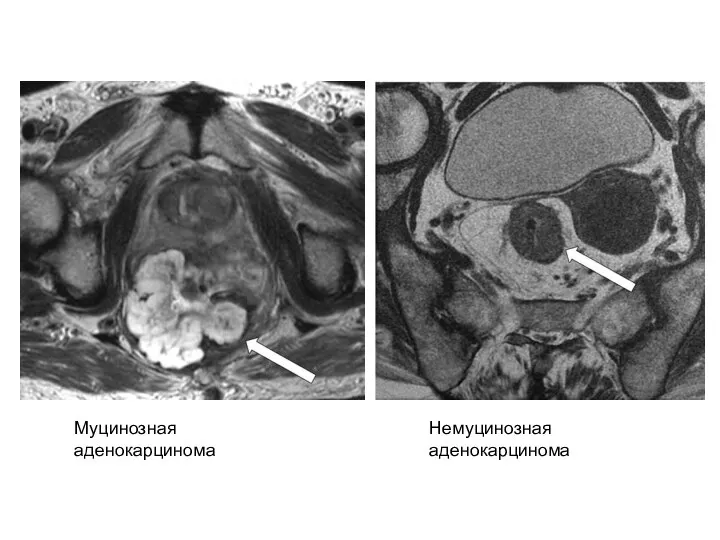 Муцинозная аденокарцинома Немуцинозная аденокарцинома