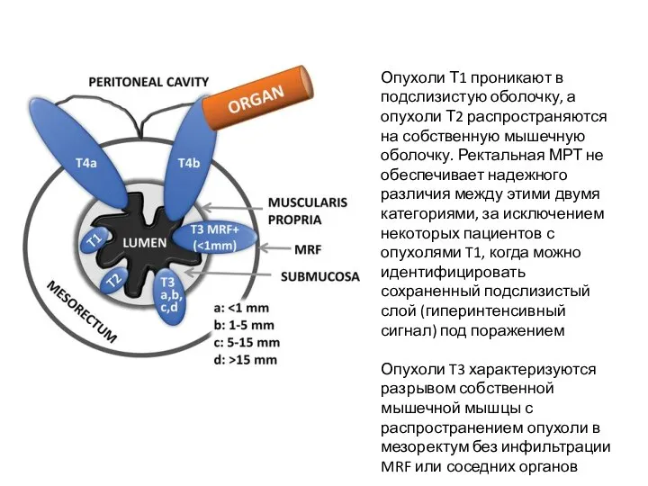 Опухоли Т1 проникают в подслизистую оболочку, а опухоли Т2 распространяются на