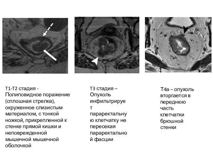 T1-T2 стадия - Полиповидное поражение (сплошная стрелка), окруженное слизистым материалом, с