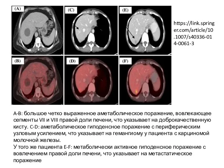 A-B: большое четко выраженное аметаболическое поражение, вовлекающее сегменты VII и VIII