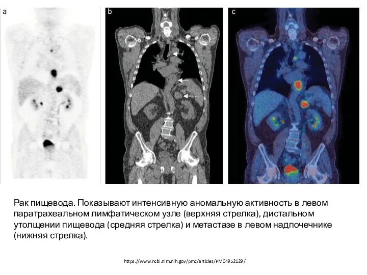 https://www.ncbi.nlm.nih.gov/pmc/articles/PMC4952129/ Рак пищевода. Показывают интенсивную аномальную активность в левом паратрахеальном лимфатическом