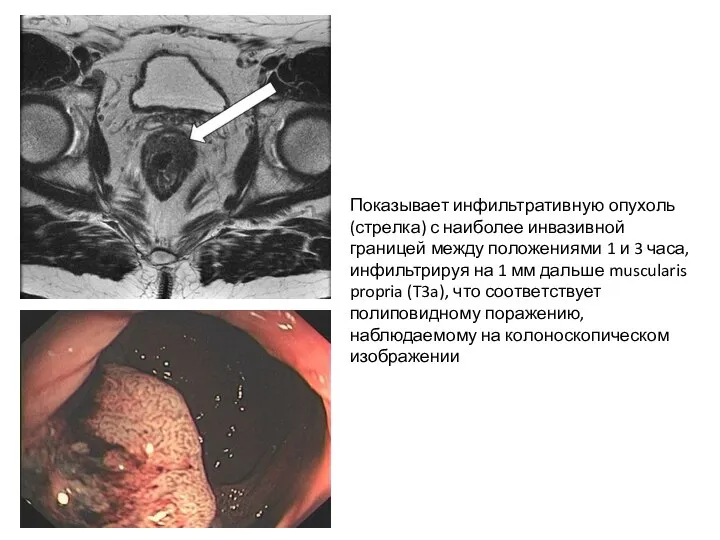 Показывает инфильтративную опухоль (стрелка) с наиболее инвазивной границей между положениями 1