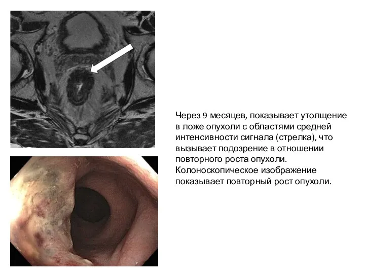 Через 9 месяцев, показывает утолщение в ложе опухоли с областями средней