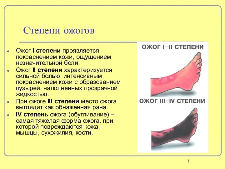 Степени ожогов Ожог I степени проявляется покраснением кожи, ощущением незначительной боли.