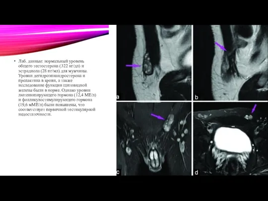 Лаб. данные: нормальный уровень общего тестостерона (322 нг/дл) и эстрадиола (28