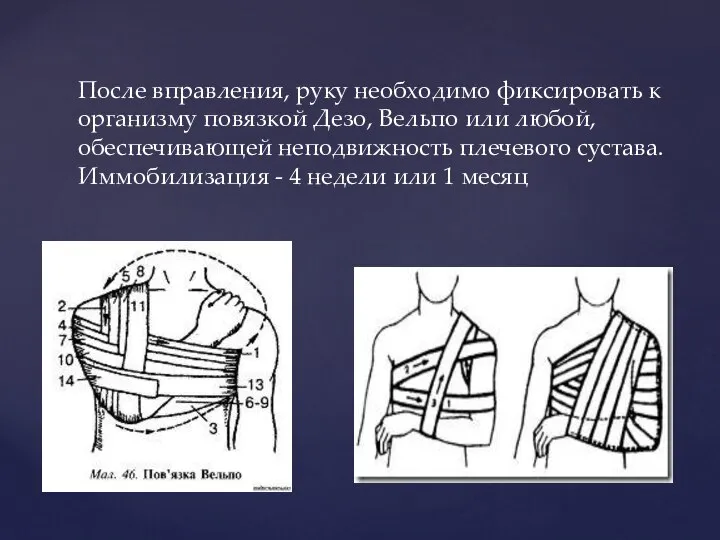 После вправления, руку необходимо фиксировать к организму повязкой Дезо, Вельпо или