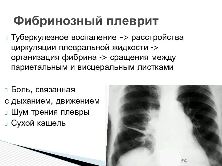 Туберкулезное воспаление –> расстройства циркуляции плевральной жидкости -> организация фибрина ->
