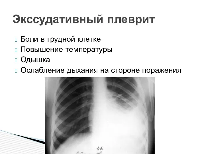 Боли в грудной клетке Повышение температуры Одышка Ослабление дыхания на стороне поражения Экссудативный плеврит