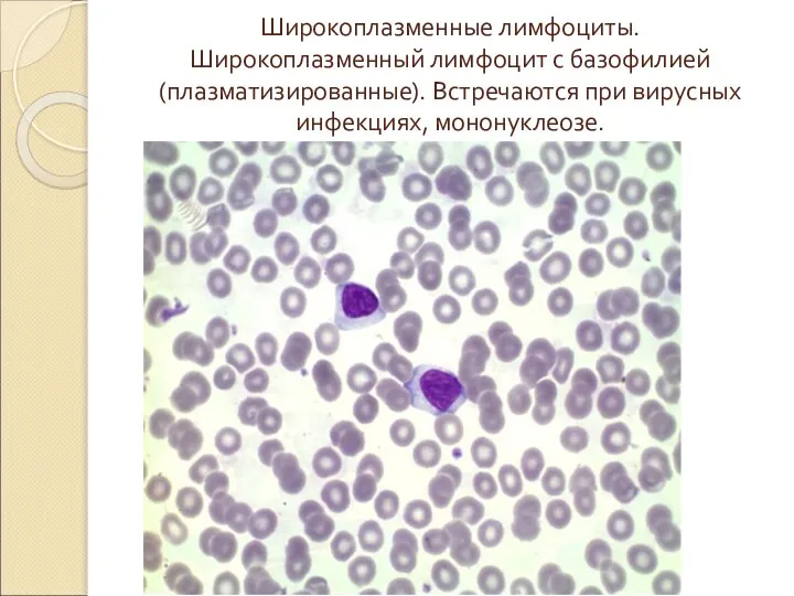 Широкоплазменные лимфоциты. Широкоплазменный лимфоцит с базофилией (плазматизированные). Встречаются при вирусных инфекциях, мононуклеозе.