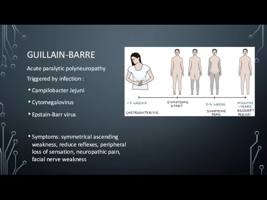 GUILLAIN-BARRE Acute paralytic polyneuropathy Triggered by infection : Campilobacter Jejuni Cytomegalovirus