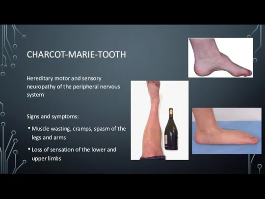CHARCOT-MARIE-TOOTH Hereditary motor and sensory neuropathy of the peripheral nervous system