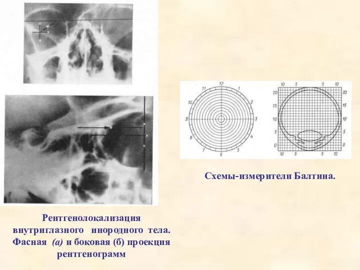 Рентгенолокализация внутриглазного инородного тела. Фасная (а) и боковая (б) проекция рентгенограмм Схемы-измерители Балтина.