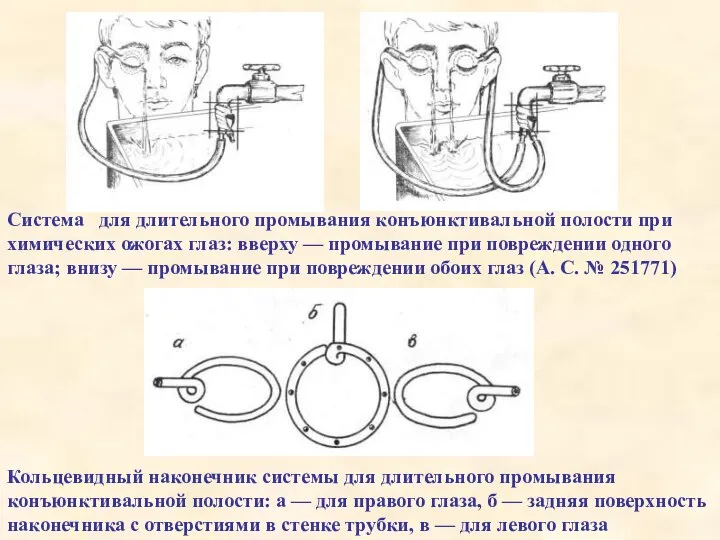 Система для длительного промывания конъюнктивальной полости при химических ожогах глаз: вверху