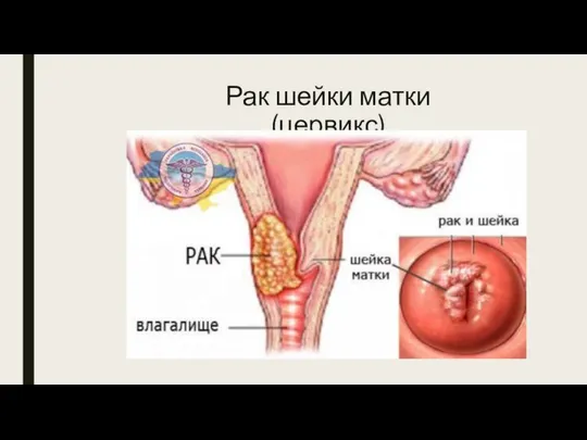 Рак шейки матки (цервикс)