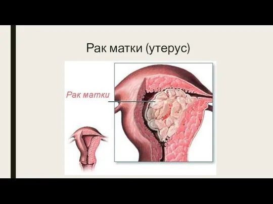 Рак матки (утерус)