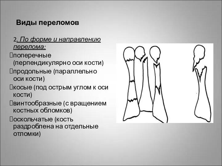 Виды переломов 2. По форме и направлению перелома: поперечные (перпендикулярно оси