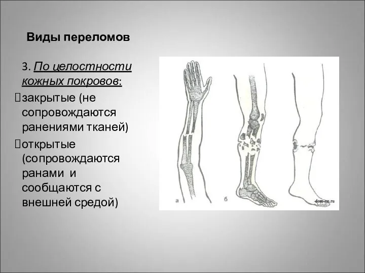 Виды переломов 3. По целостности кожных покровов: закрытые (не сопровождаются ранениями