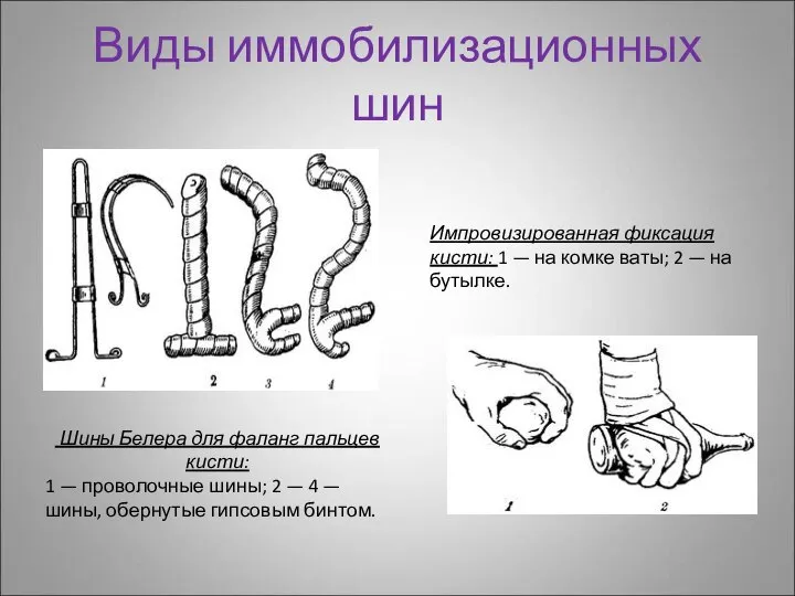 Виды иммобилизационных шин Шины Белера для фаланг пальцев кисти: 1 —