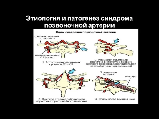 Этиология и патогенез синдрома позвоночной артерии