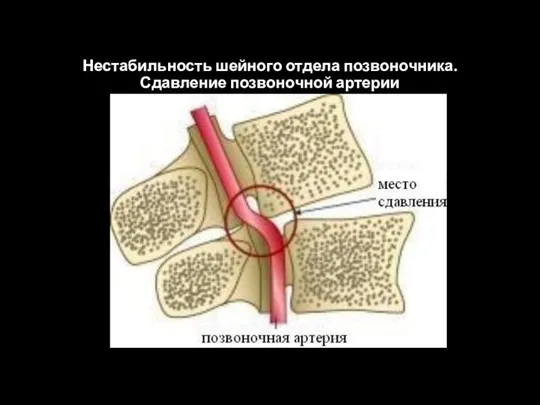 Нестабильность шейного отдела позвоночника. Сдавление позвоночной артерии