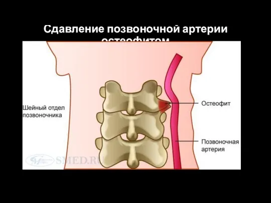 Сдавление позвоночной артерии остеофитом