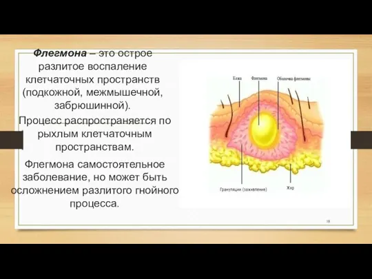 Флегмона – это острое разлитое воспаление клетчаточных пространств (подкожной, межмышечной, забрюшинной).